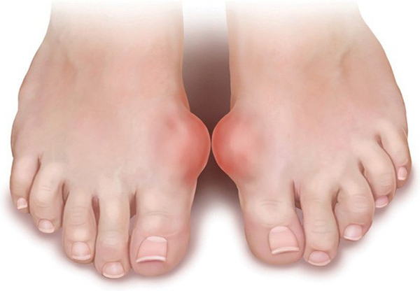 Viêm khớp ngón chân gây ảnh hưởng đến khả năng vận động, làm việc của người bệnh